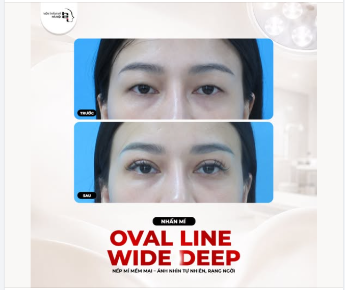 NHẤN MÍ OVAL LINE WIDE DEEP