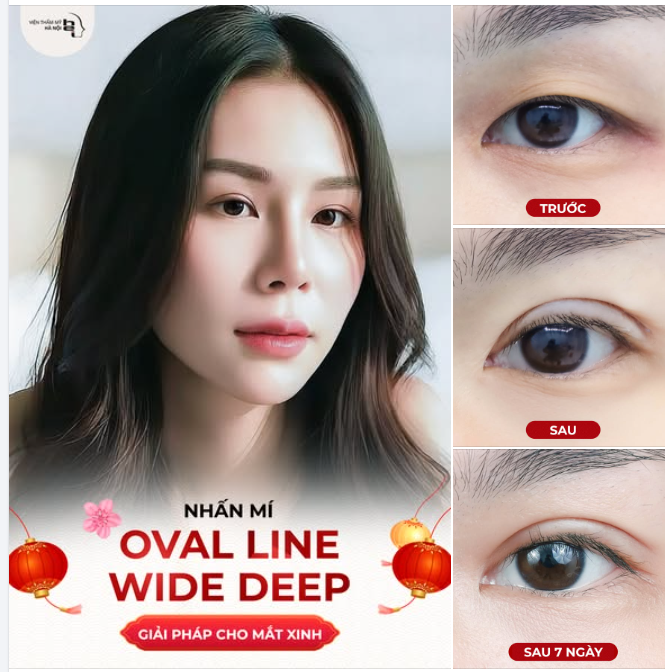 NHẤN MÍ OVAL LINE WIDE DEEP  MẮT SANG – MÍ SÂU – VISUAL “LÊN HẠNG”