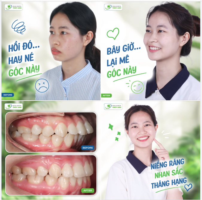 TỪ RĂNG HÔ, CHÌA ĐẾN MỘT GÓC NGHIÊNG HÀI HÒA HƠN