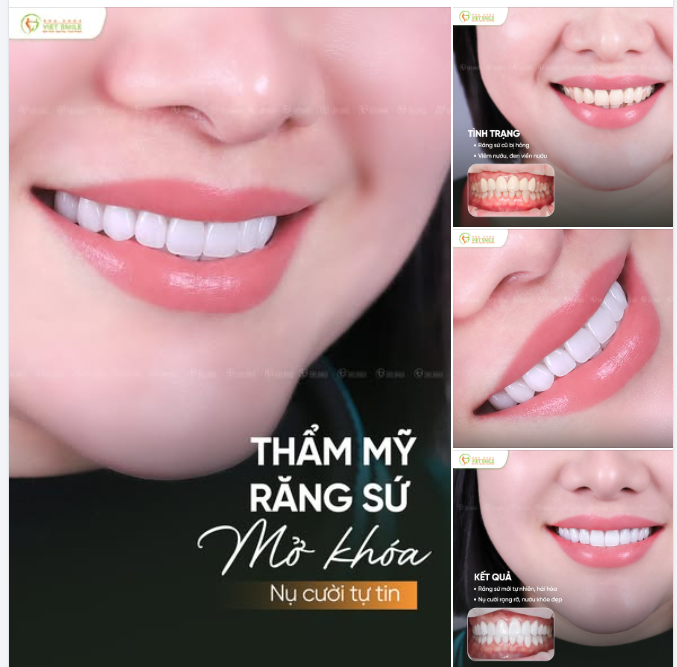 TÁI SINH RĂNG SỨ HỎNG – F5 NỤ CƯỜI, ĐÓN DIỆN MẠO MỚI!