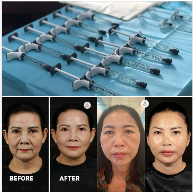 Bị khóe mũi miệng sâu thì cải thiện như thế nào?