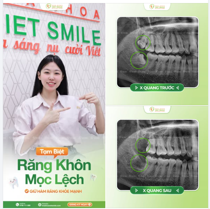 TẠM BIỆT RĂNG KHÔN MỌC LỆCH – GIỮ HÀM RĂNG KHỎE MẠNH
