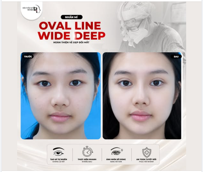 NHẤN MÍ OVAL LINE WIDE DEEP ​​​​​​​  MẮT SANG – MÍ SÂU – VISUAL “LÊN HẠNG”