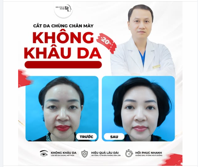 CẮT DA CHÙNG CHÂN MÀY KHÔNG KHÂU DA: GIẢI CỨU ĐÔI MẮT SỤP MÍ – LẤY LẠI 10 NĂM TUỔI XUÂN