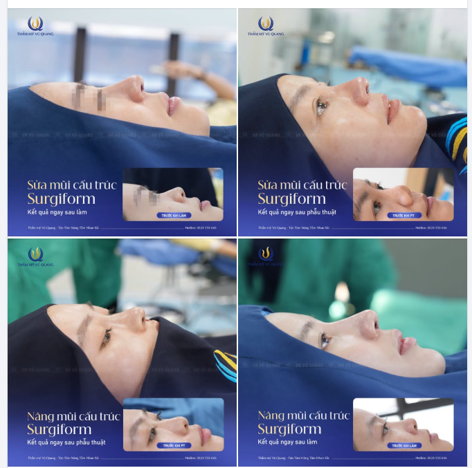 Cùng nhìn lại những ca nâng mũi / sửa mũi vừa được Thạc sĩ - Bác sĩ Vũ Quang trực tiếp thực hiện gần đây.