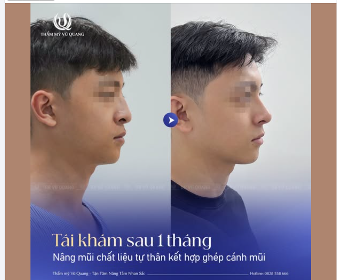 NÂNG MŨI NAM – NAM TÍNH, MẠNH MẼ VÀ ĐẦY KHÍ CHẤT!