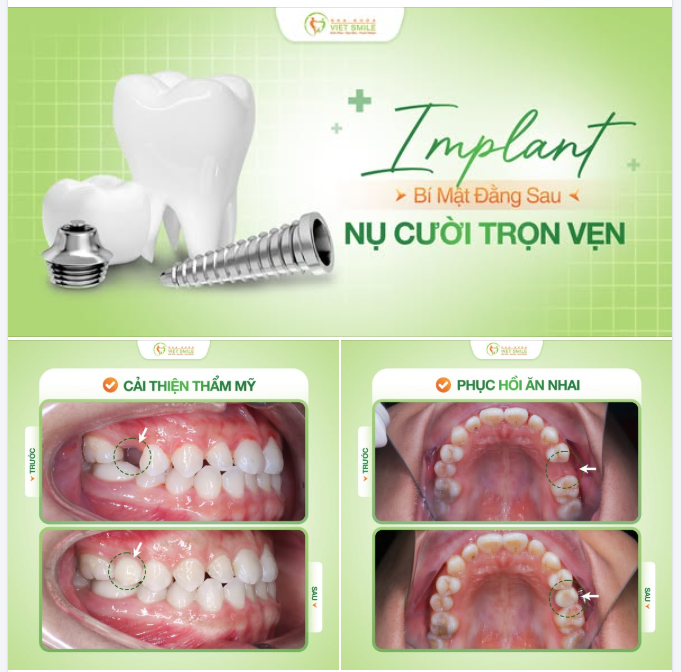 BÍ MẬT ĐẰNG SAU MỘT NỤ CƯỜI TRỌN VẸN