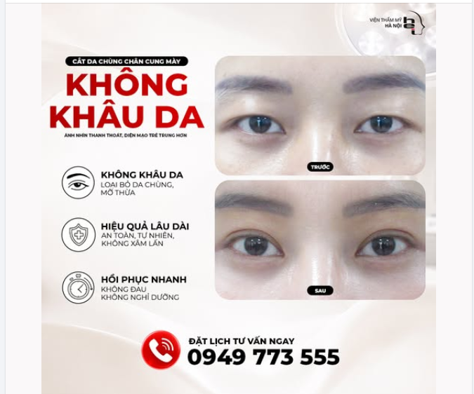 Bạn có biết tác hại của hiện tượng Da chùng mí mắt