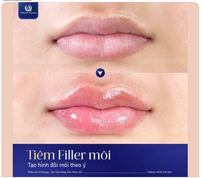 Chỉ 30 phút cho một đôi môi căng mọng, xinh xăn – Sao lại không nhỉ?
