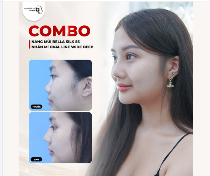 Xinh đẹp hơn với Combo Nâng mũi Bella Silk 5S + Nhấn mí Oval Line Wide Deep.