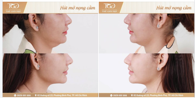 Vùng mỡ dưới cằm có thể khiến đường viền hàm kém rõ nét, khuôn mặt nhìn đầy đặn và góc cổ–cằm thiếu sự thanh thoát.