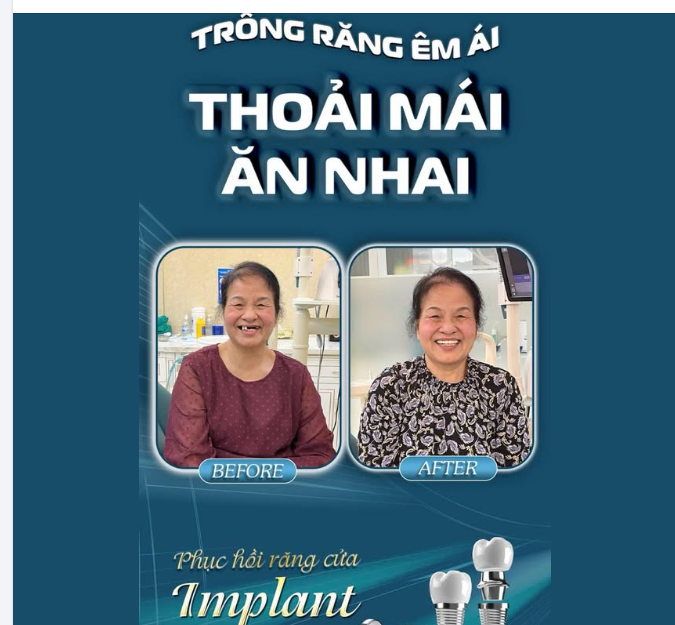 TRỒNG RĂNG ÊM ÁI – THOẢI MÁI ĂN NHAI - TỰ TIN CƯỜI XINH