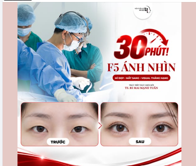 NHẤN MÍ OVAL LINE WIDE DEEP – MẮT SANG, THẦN THÁI THĂNG HẠNG