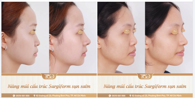Khi tìm hiểu về nâng mũi, nhiều khách hàng thường quan tâm trước tiên đến sụn gì, chất liệu gì. Tuy nhiên, chất liệu chỉ là một phần trong quá trình tạo nên kết quả.