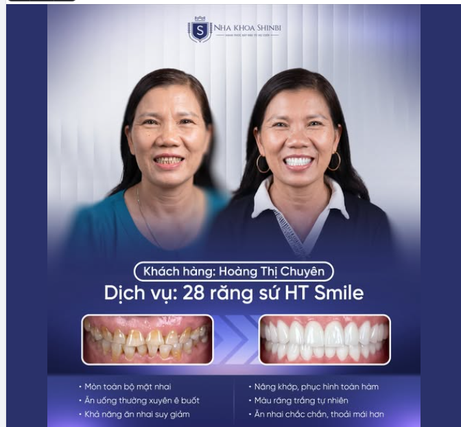 “TRẺ RA 10 TUỔI” NHỜ NỤ CƯỜI MỚI, ĂN NHAI CŨNG THOẢI MÁI HƠN!