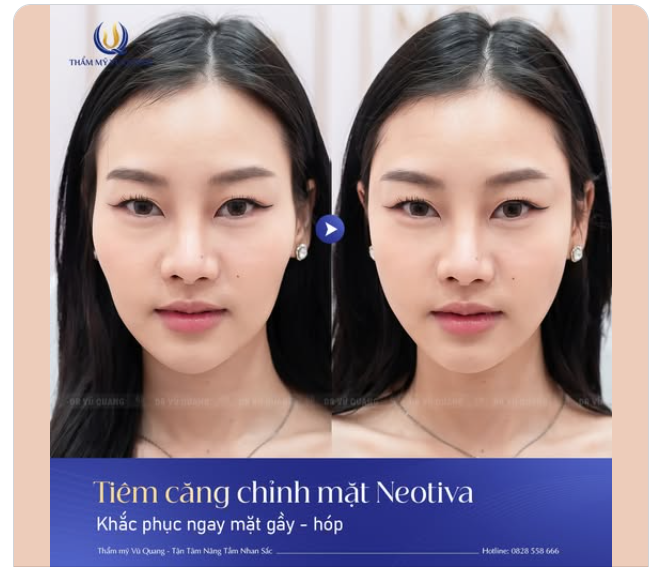 TẠM BIỆT MẶT HÓP GẦY – CĂN CHỈNH DIỆN MẠO CÙNG FILLER NEOTIVA