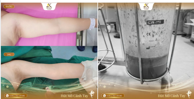 HÚT MỠ CÁNH TAY – KHÔNG CHỈ LÀ GIẢM MỠ, MÀ LÀ TẠO LẠI ĐƯỜNG NÉT