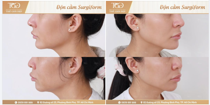 Filler là một trong những giải pháp giúp cải thiện dáng cằm hiệu quả, nhanh, tiết kiệm chi phí mà nhiều khách hàng lựa chọn.