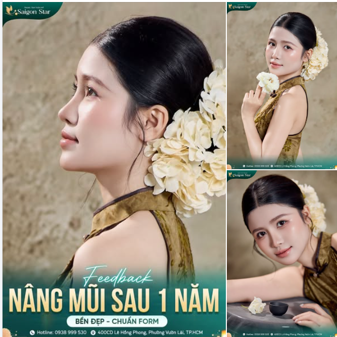 FEEDBACK SAU 1 NĂM NÂNG MŨI CẤU TRÚC DR. HOẠT