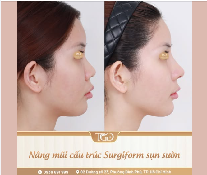 Một dáng mũi hài hòa không chỉ được quyết định bởi độ cao của sống mũi mà là kết quả của quá trình đánh giá nền mũi, tái cấu trúc phù hợp và cân chỉnh từng đường nét theo tổng thể gương mặt.