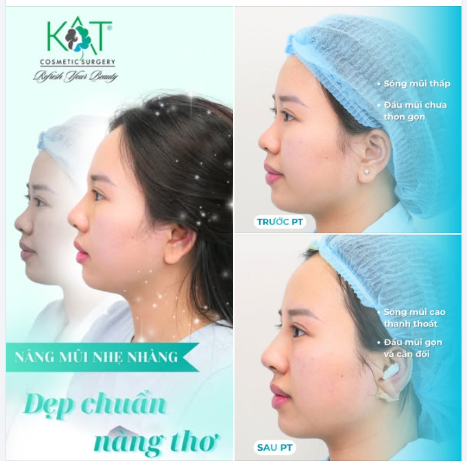 Nâng mũi nhẹ nhàng, thay đổi vừa đủ để gương mặt cân đối hơn.