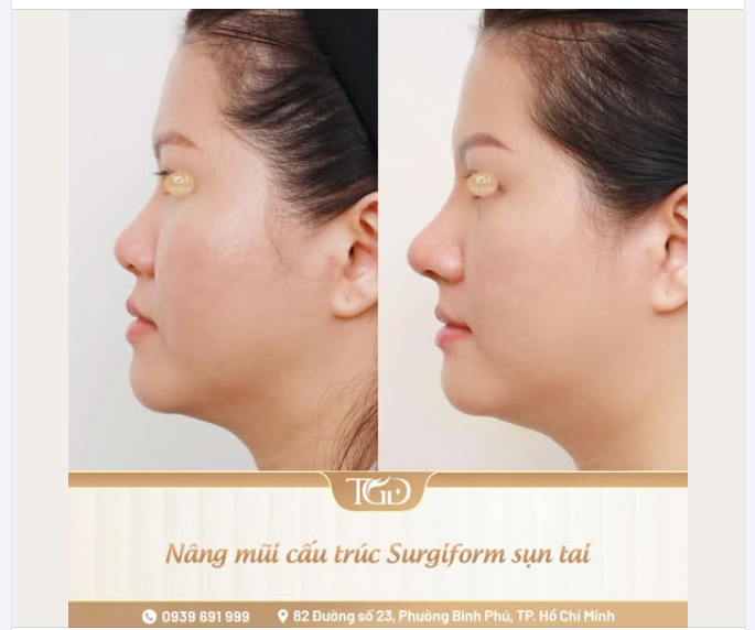 Không phải trường hợp nâng mũi nào cũng cần sử dụng sụn tai.