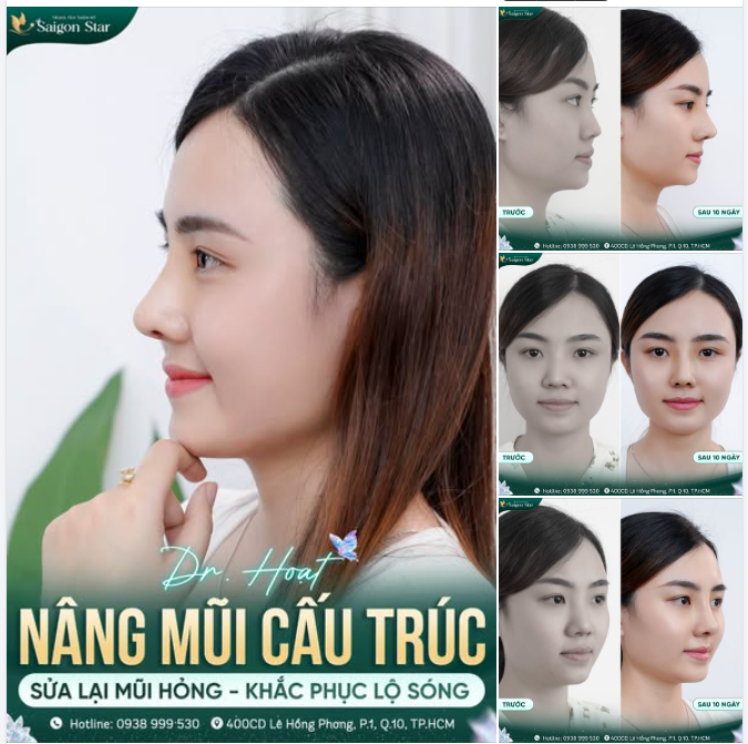 SỬA MŨI HỎNG, KHẮC PHỤC LỘ SÓNG: 10 NGÀY CHUẨN FORM