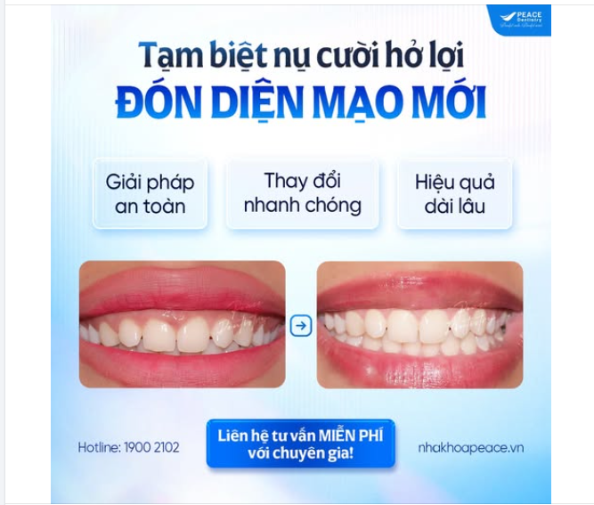 CHỮA CƯỜI HỞ LỢI - ĐÓN NỤ CƯỜI TỰ TIN