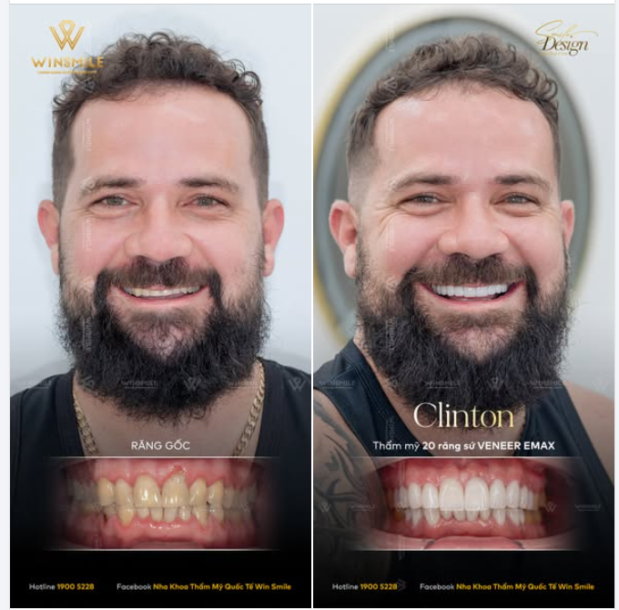 DÁN VENEER CHO PHÁI MẠNH - ĐẸP TỰ NHIÊN, ƯU TIÊN BẢO TỒN RĂNG THẬT