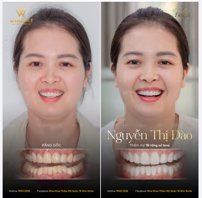 Có một sự khác biệt tinh tế giữa việc "sửa lại" một nụ cười và việc thấu hiểu nó đủ sâu để biết nên chạm vào đâu, với chị Đào, Win Smile chọn cách thứ hai