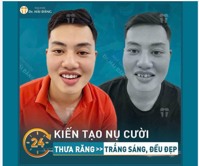 TỰ TIN CƯỜI RẠNG RỠ CHỈ SAU LẦN ĐẦU TIÊN!