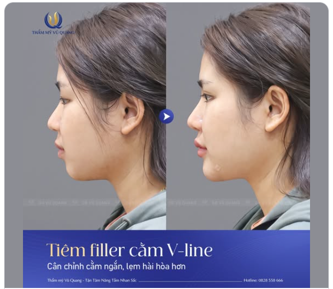 CẰM V-LINE - CHÌA KHÓA CHO GƯƠNG MẶT THANH TÚ CHỈ SAU 15 PHÚT!