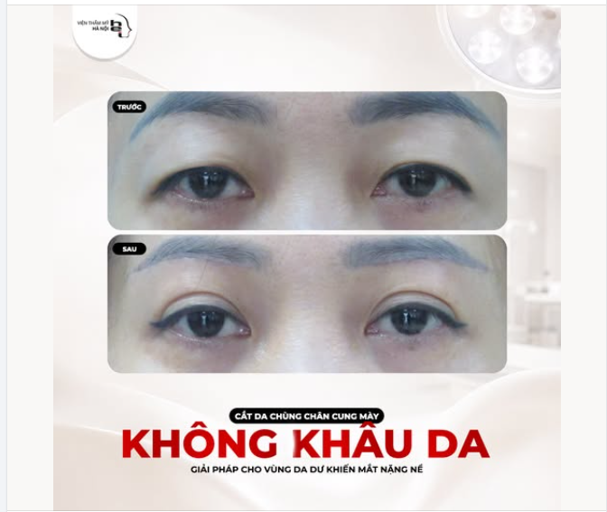 TRẺ HÓA ĐÔI MẮT VỚI CẮT DA CHÙNG CHÂN MÀY KHÔNG KHÂU DA
