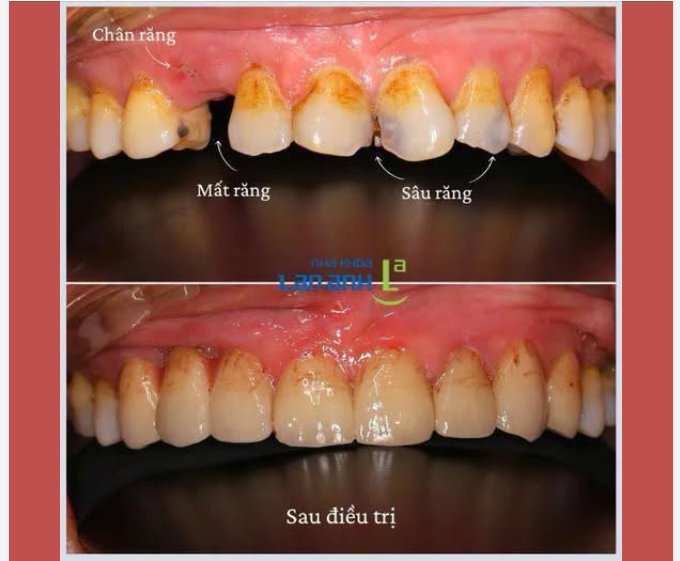 Với bệnh nhân lớn tuổi, ngại thăm khám định kỳ, việc phát hiện nhiều vấn đề răng miệng khi đến nha khoa là khá thường gặp.
