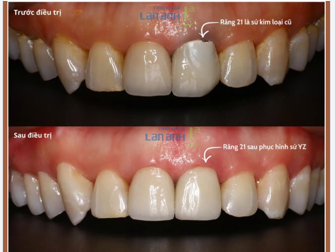 Thay áo mới cho răng 21