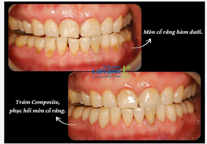 MÒN CỔ RĂNG - ĐỪNG CHỜ ĐẾN KHI RĂNG Ê BUỐT