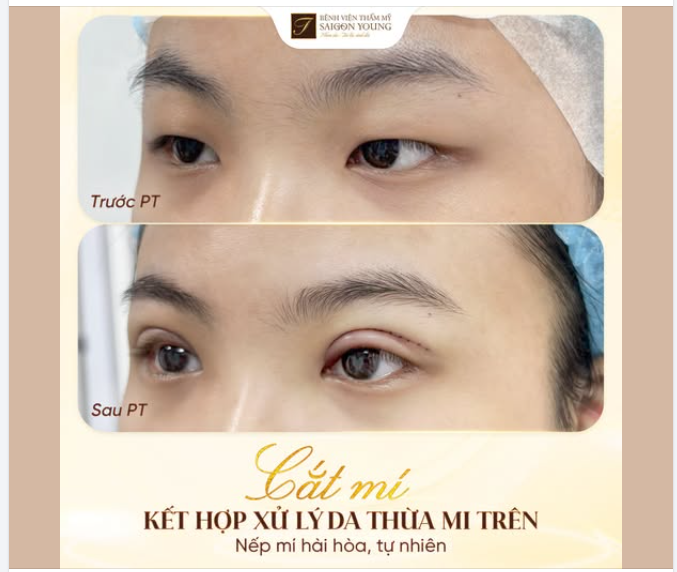 Cắt mí, xử lý da thừa mí trên, giúp đôi mắt rõ nếp mí, thần thái rạng rỡ