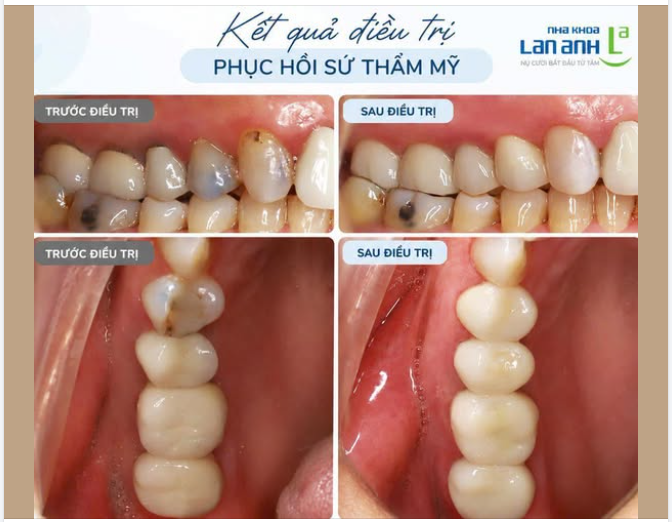 CẦU SỨ CŨ BỊ HỞ - THAY MỚI BẰNG CERCON