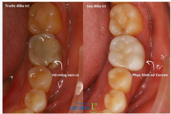 Có những chiếc răng nhìn tưởng chỉ cần trám lại… nhưng thực tế cần được bảo vệ nhiều hơn.