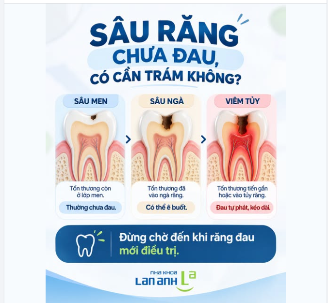 SÂU RĂNG CHƯA ĐAU, CÓ CẦN TRÁM KHÔNG?