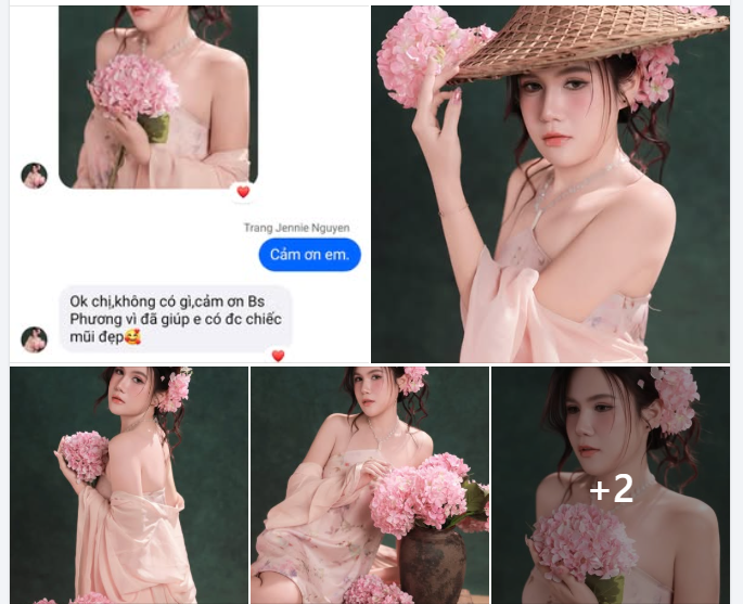 3 NĂM SAU NÂNG MŨI SỤN SƯỜN TOÀN PHẦN