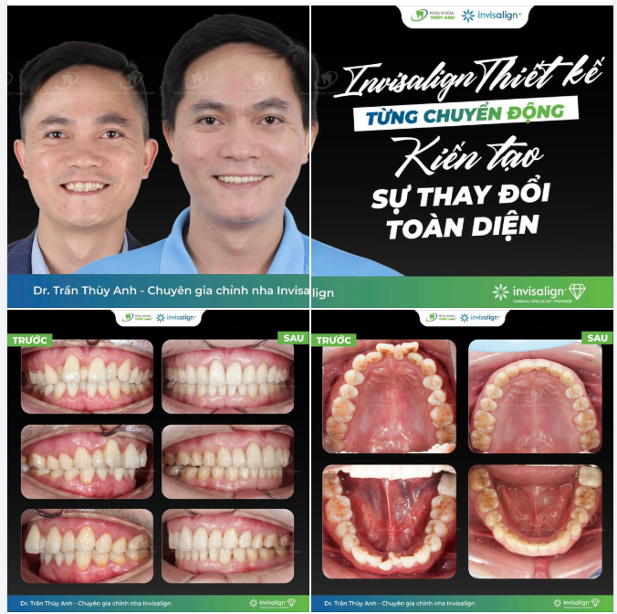 40 TUỔI CÓ CÒN NIỀNG RĂNG ĐƯỢC KHÔNG?  CA INVISALIGN ĐÓNG KHE THƯA DO RĂNG KẸ "TÁI SINH" LẠI NỤ CƯỜI Ở TUỔI U40