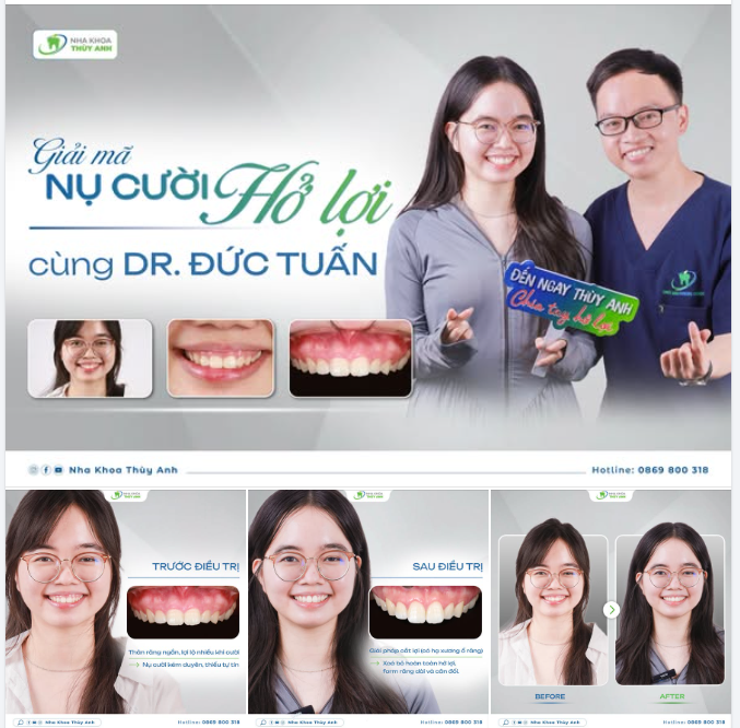 GIẢI MÃ NỤ CƯỜI HỞ LỢI CÙNG DR. ĐỨC TUẤN