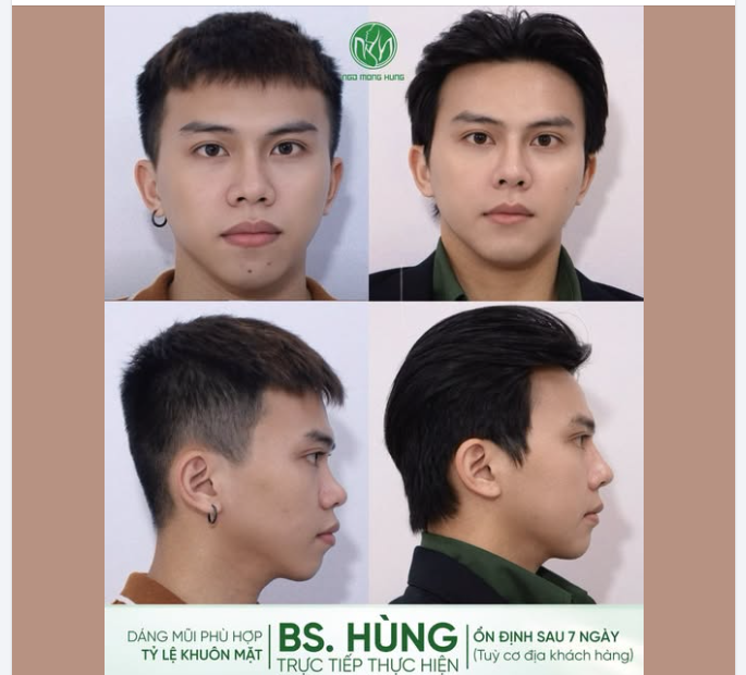 Chấm bao nhiêu điểm cho dáng mũi nam này ạ?
