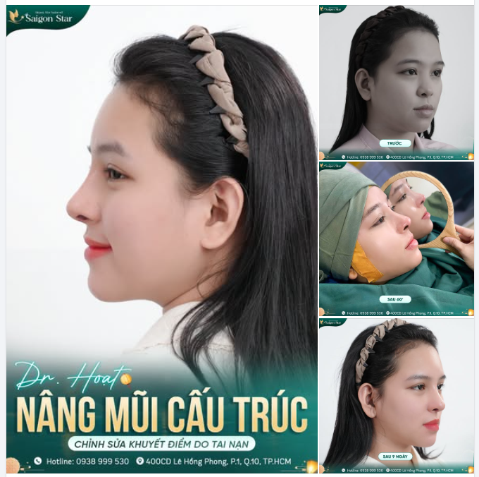 NÂNG MŨI CẤU TRÚC – KHẮC PHỤC KHUYẾT ĐIỂM SAU TAI NẠN