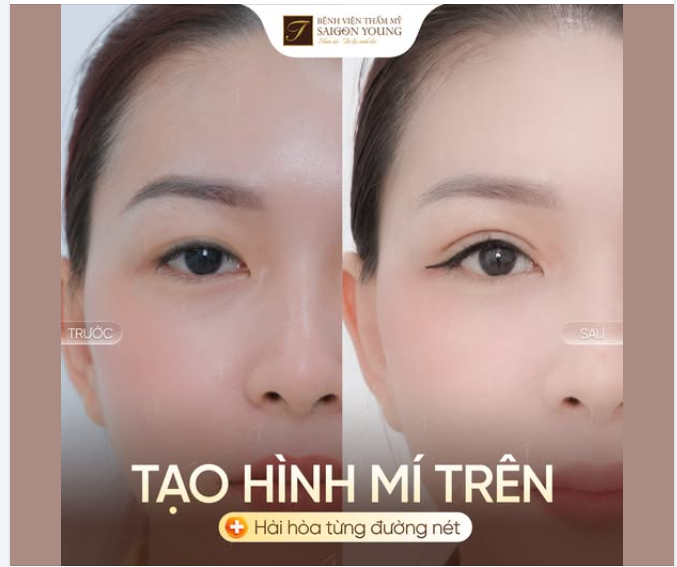 KHẮC PHỤC MÍ LÓT MỜ NHẠT: NẾP MÍ VÀO FORM TỰ NHIÊN SAU 1 THÁNG