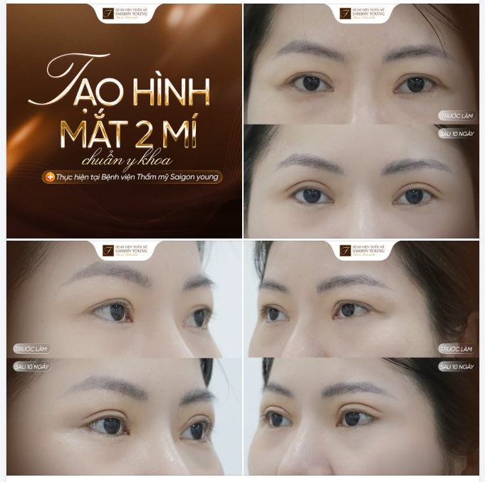 TẠM BIỆT DA CHÙNG MÍ MẮT - CHỈ SAU 10 NGÀY