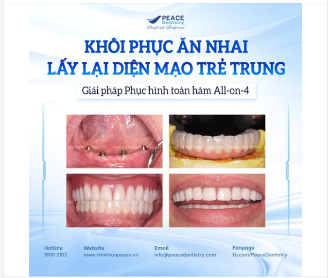 MẤT RĂNG TOÀN HÀM: ĐÂU LÀ GIẢI PHÁP PHỤC HỒI TỐI ƯU?