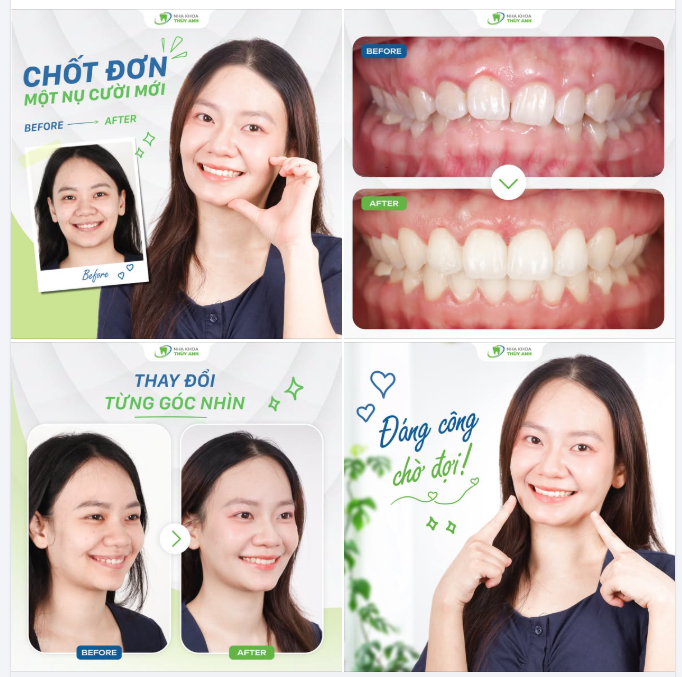 KHI NHỮNG CHI TIẾT NHỎ TRÊN HÀM RĂNG TẠO NÊN MỘT THAY ĐỔI LỚN