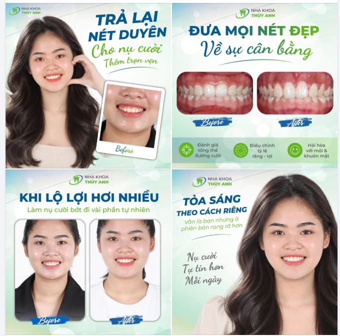NỤ CƯỜI TRỌN VẸN HƠN TỪ NHỮNG CÂN CHỈNH TINH TẾ